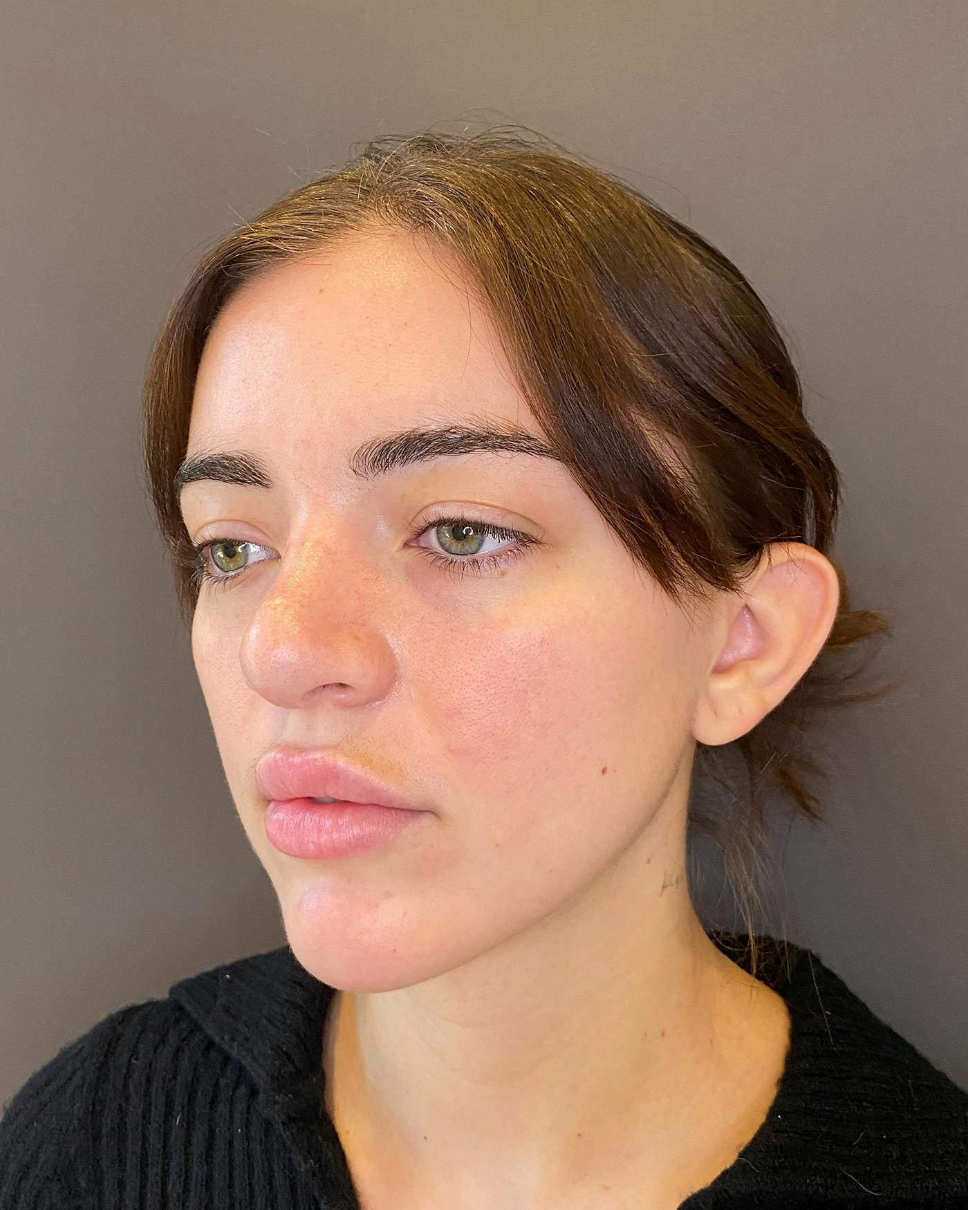 Rhinoplasty Before & After Gallery - Patient 191298628 - Image 7