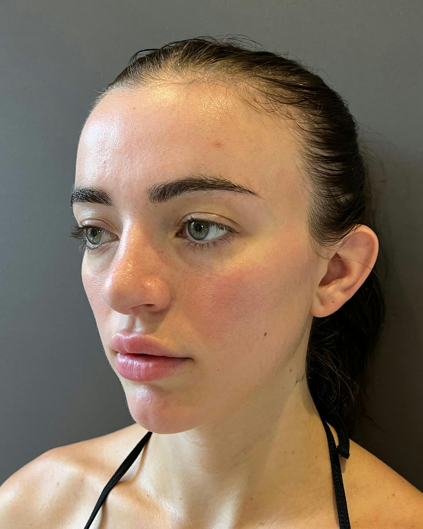 Rhinoplasty after in NYC with Albert Plastic Surgery left profile view p#3