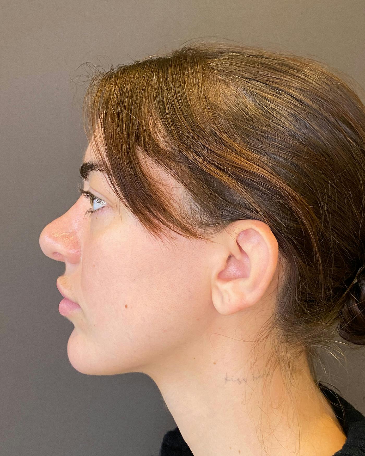Rhinoplasty Before & After Gallery - Patient 191298628 - Image 9