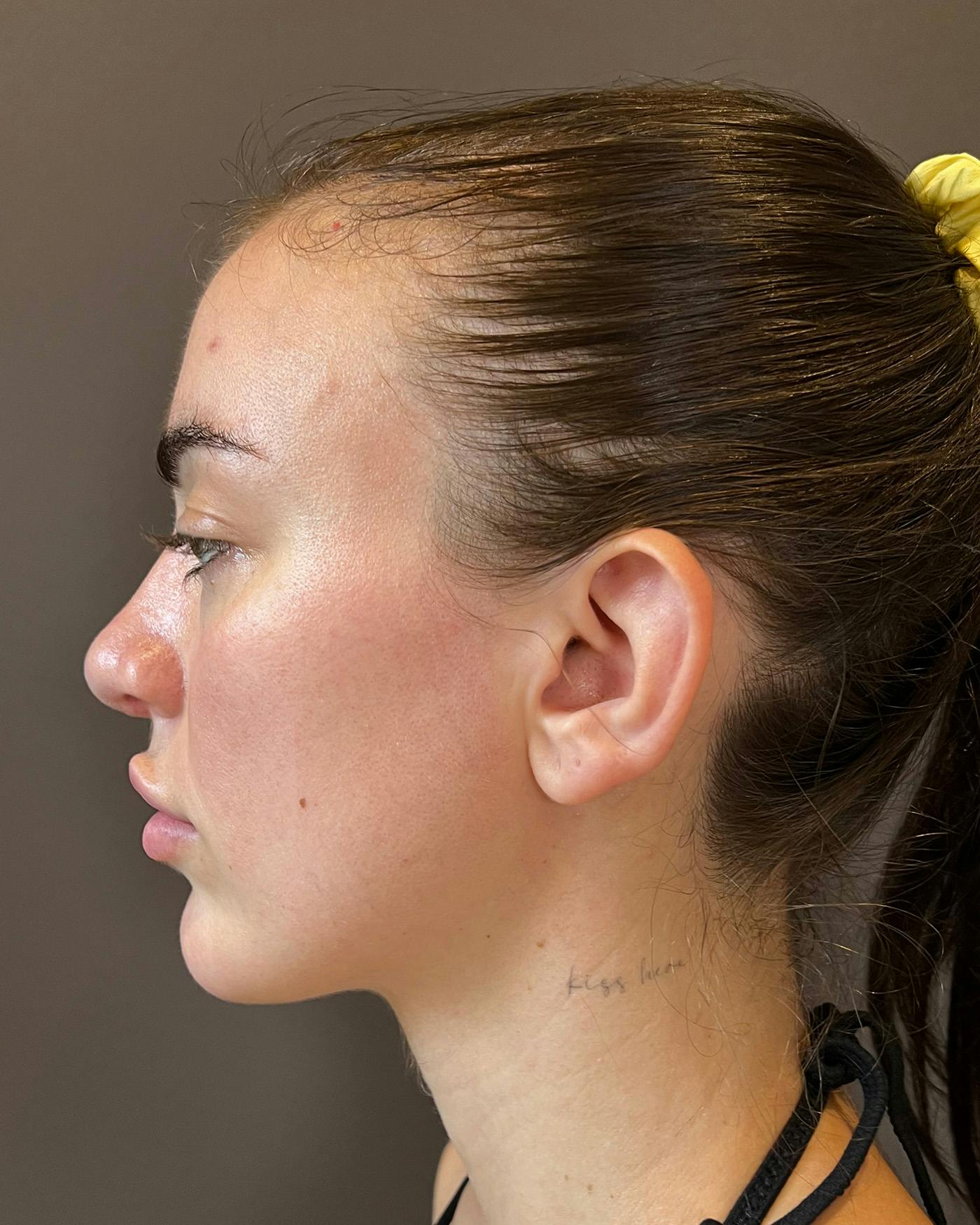 Rhinoplasty Before & After Gallery - Patient 191298628 - Image 10