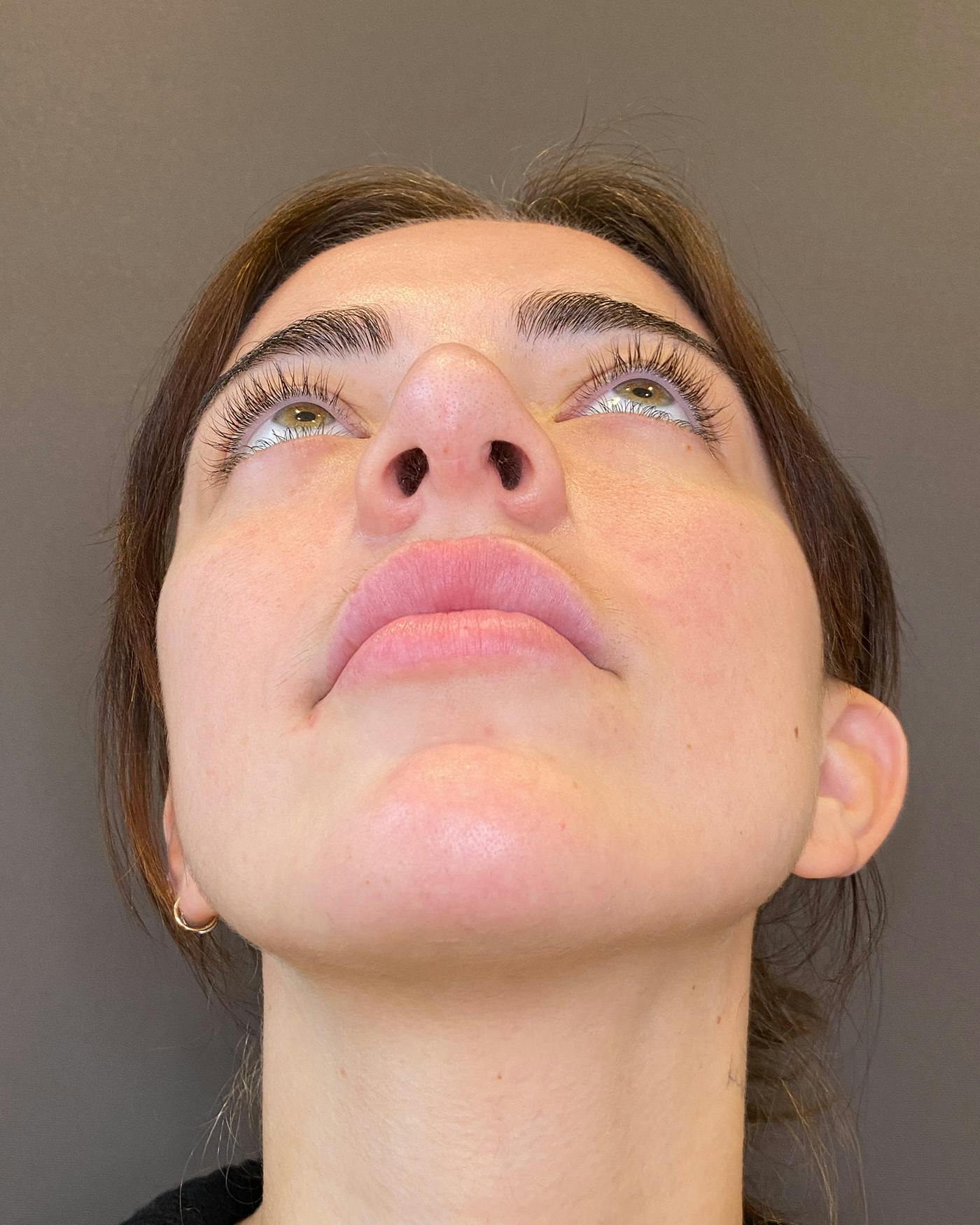 Rhinoplasty before in NYC with Albert Plastic Surgery under view p#3