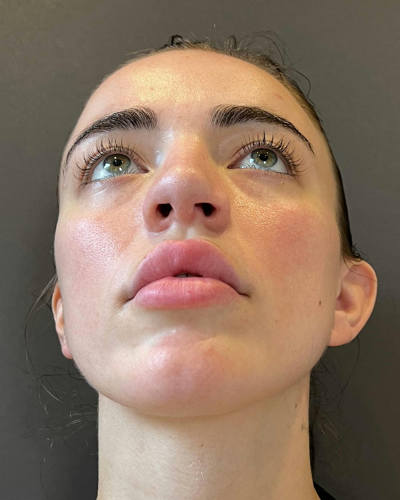 Rhinoplasty after in NYC with Albert Plastic Surgery under view p#3