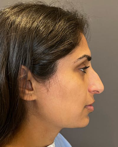 Rhinoplasty before in NYC with Albert Plastic Surgery right side view p#2
