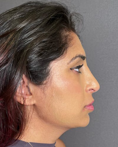 Rhinoplasty after in NYC with Albert Plastic Surgery right side view p#2