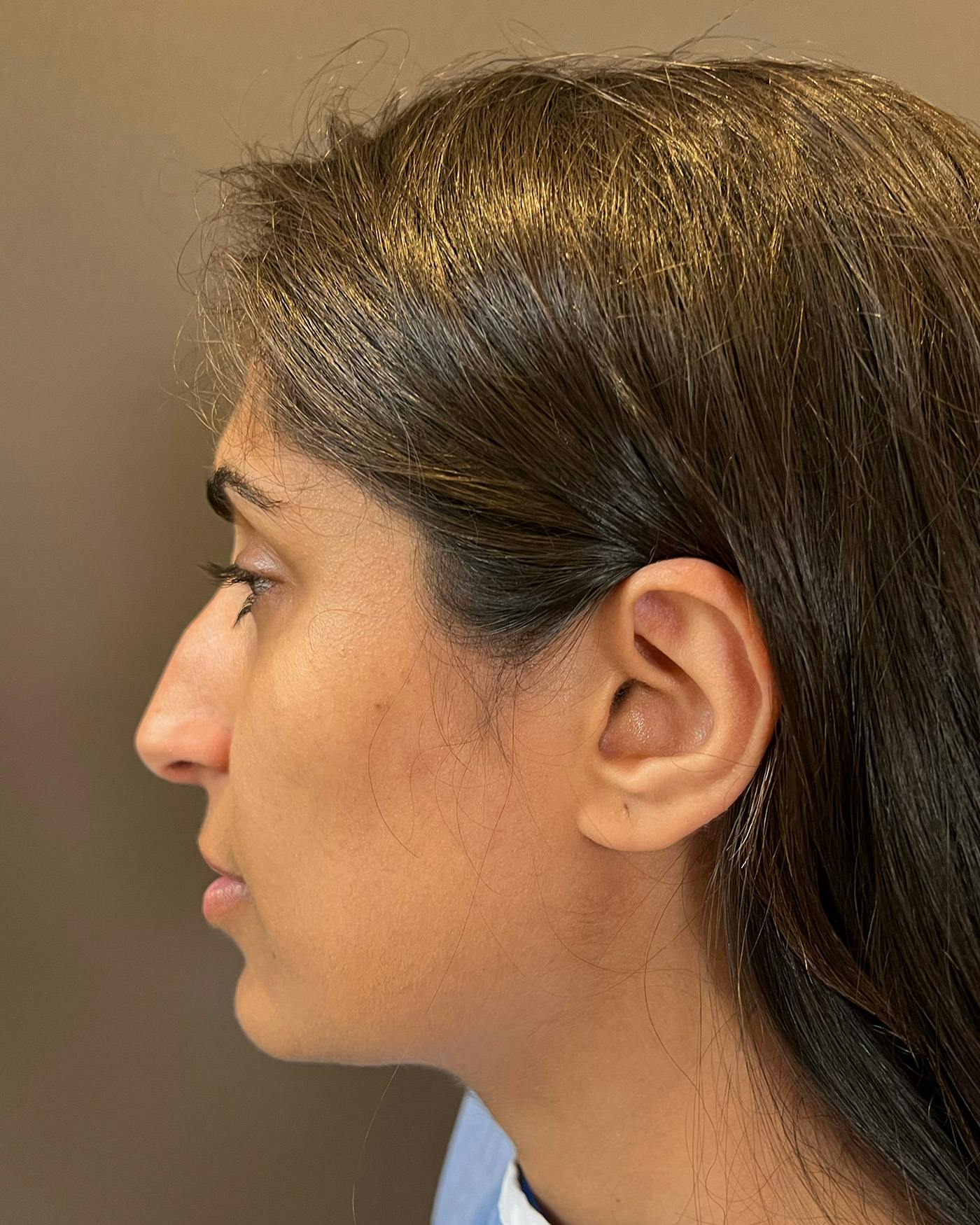 Rhinoplasty before in NYC with Albert Plastic Surgery left side view p#2