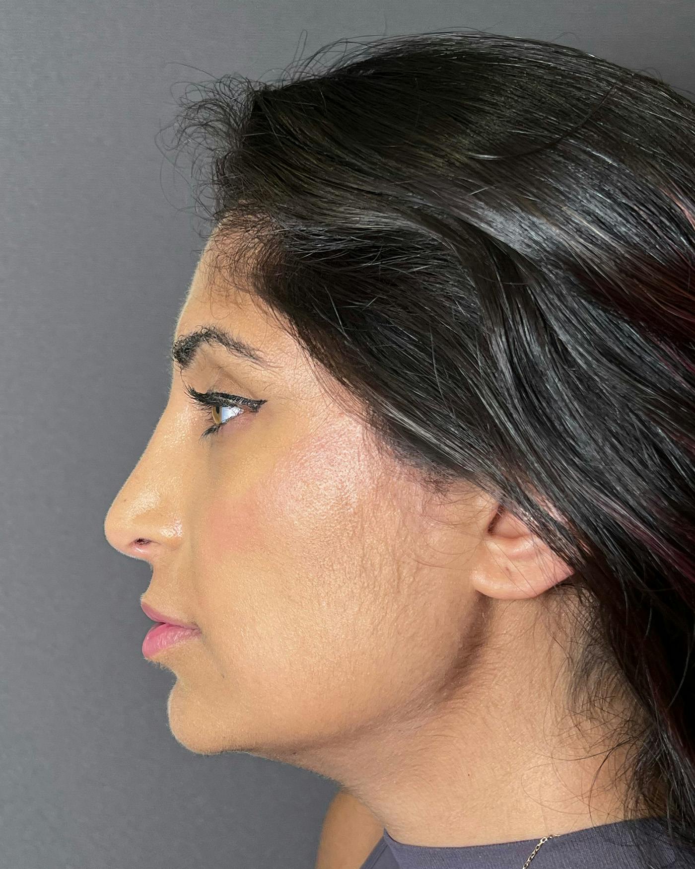 Rhinoplasty after in NYC with Albert Plastic Surgery left side view p#2
