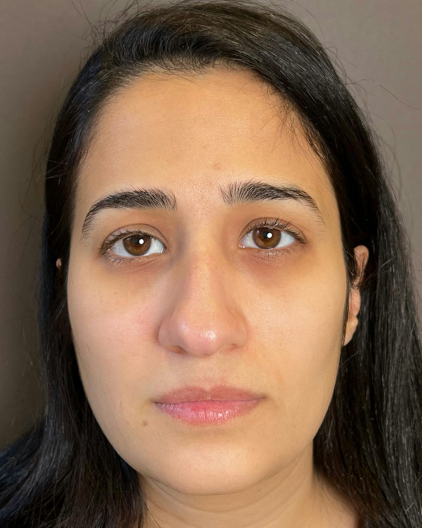 Rhinoplasty Before & After Gallery - Patient 191299778 - Image 3