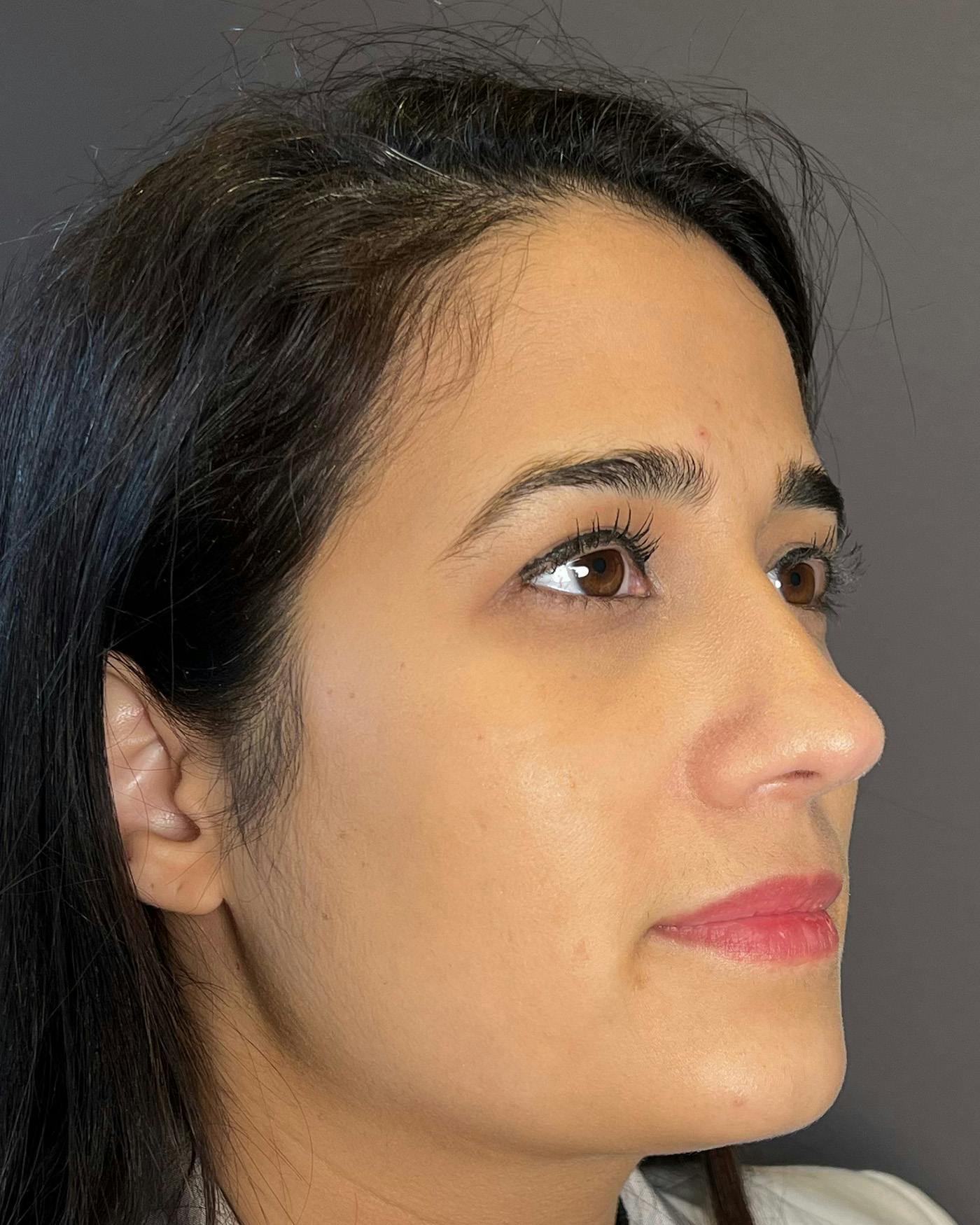 Rhinoplasty after in NYC with Albert Plastic Surgery right profile view