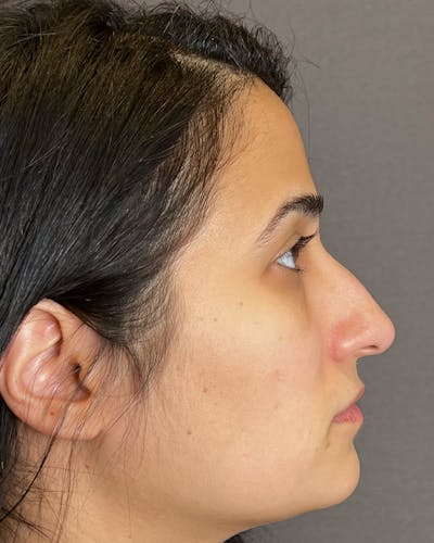 Rhinoplasty before in NYC with Albert Plastic Surgery