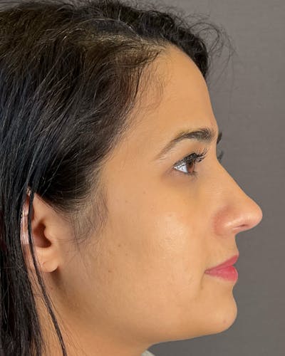 Rhinoplasty after in NYC with Albert Plastic Surgery