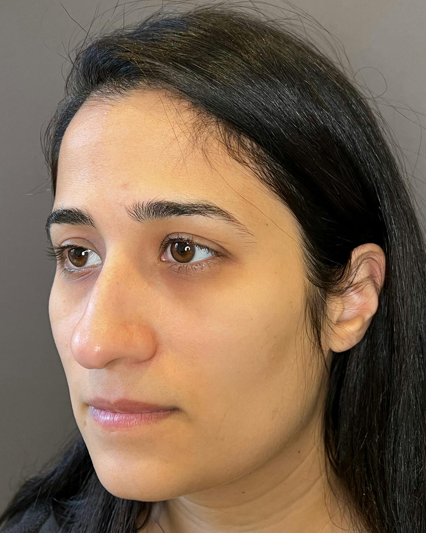 Rhinoplasty before in NYC with Albert Plastic Surgery left profile view