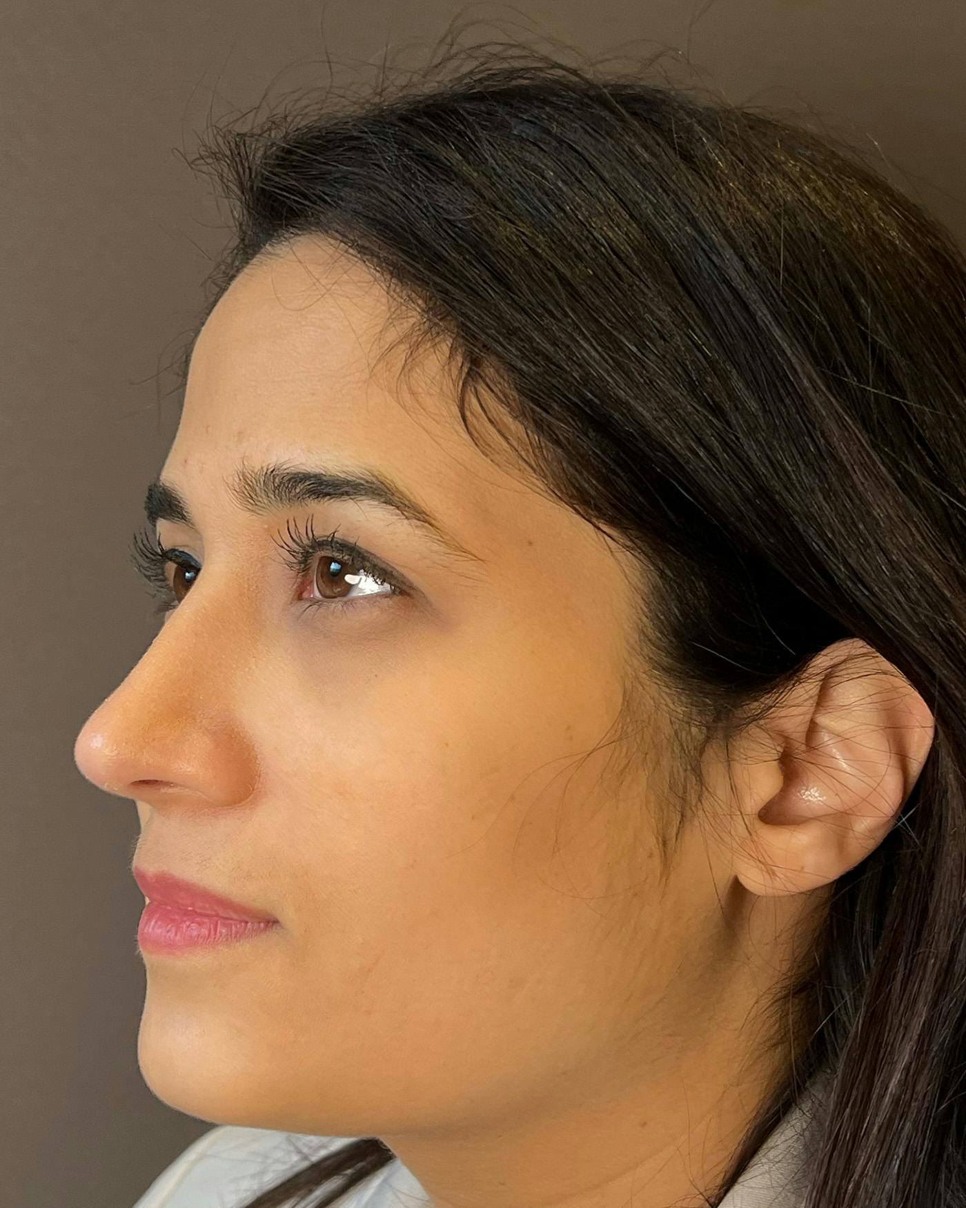 Rhinoplasty after in NYC with Albert Plastic Surgery right profile view