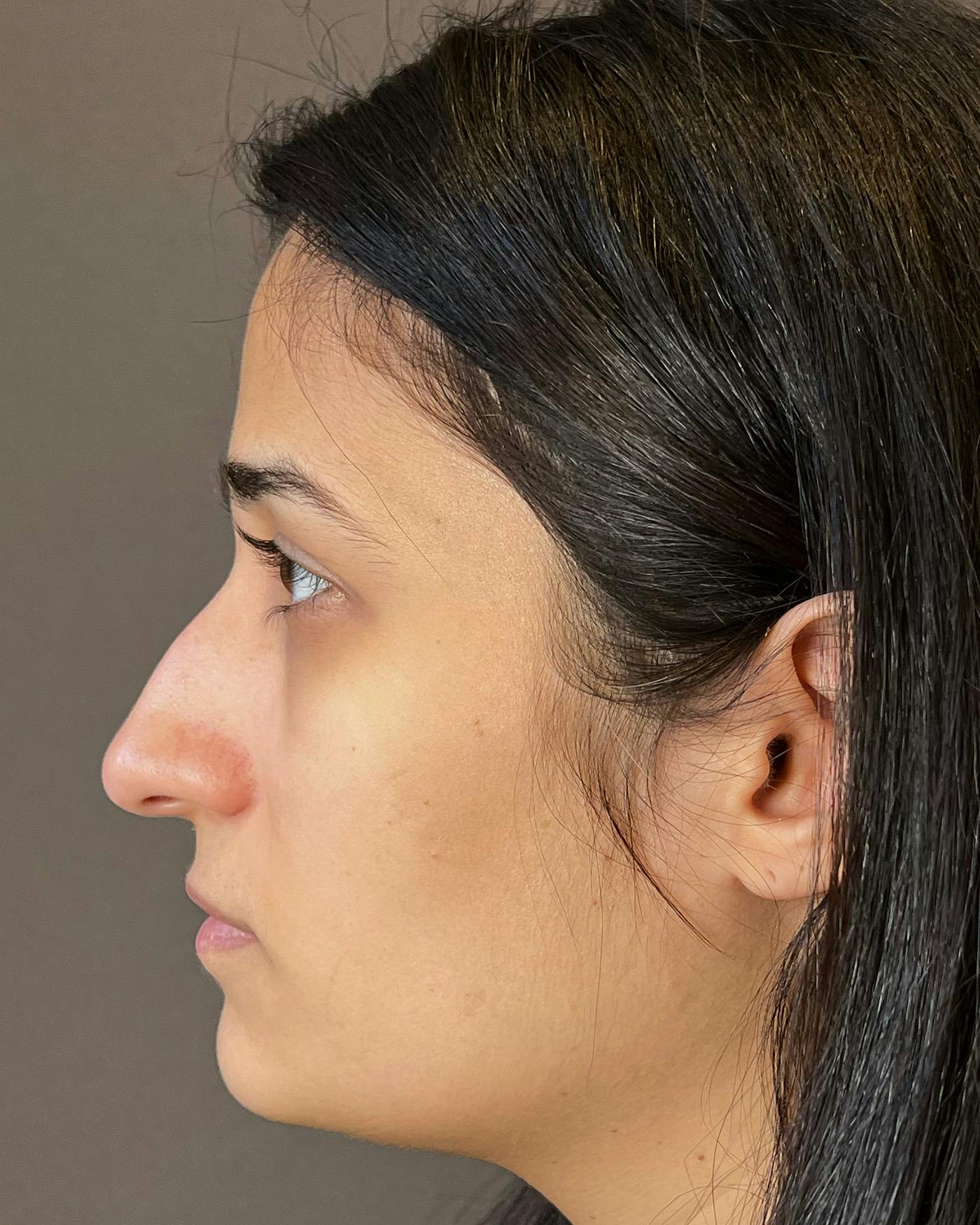 Rhinoplasty before in NYC with Albert Plastic Surgery left side view