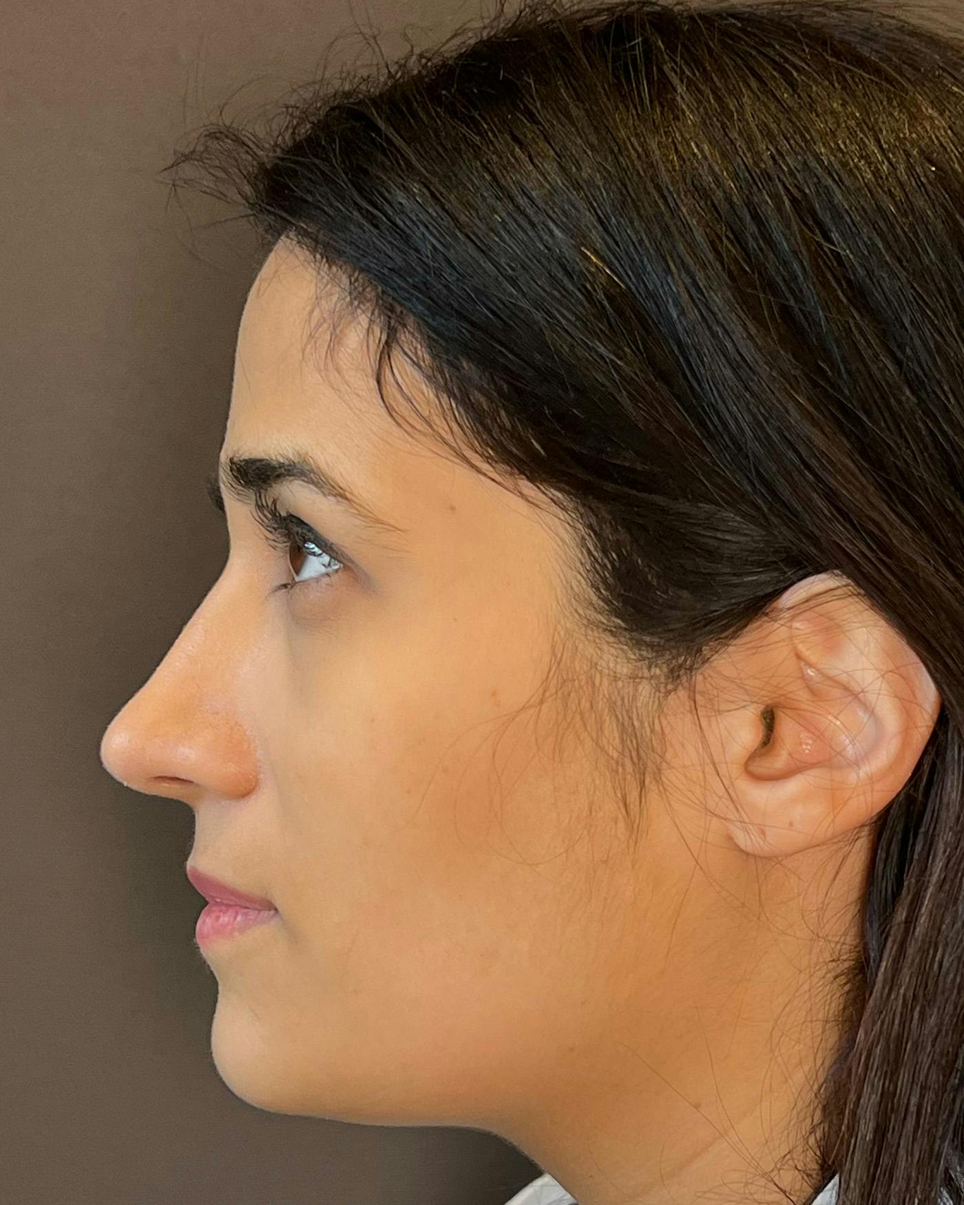 Rhinoplasty after in NYC with Albert Plastic Surgery left side view