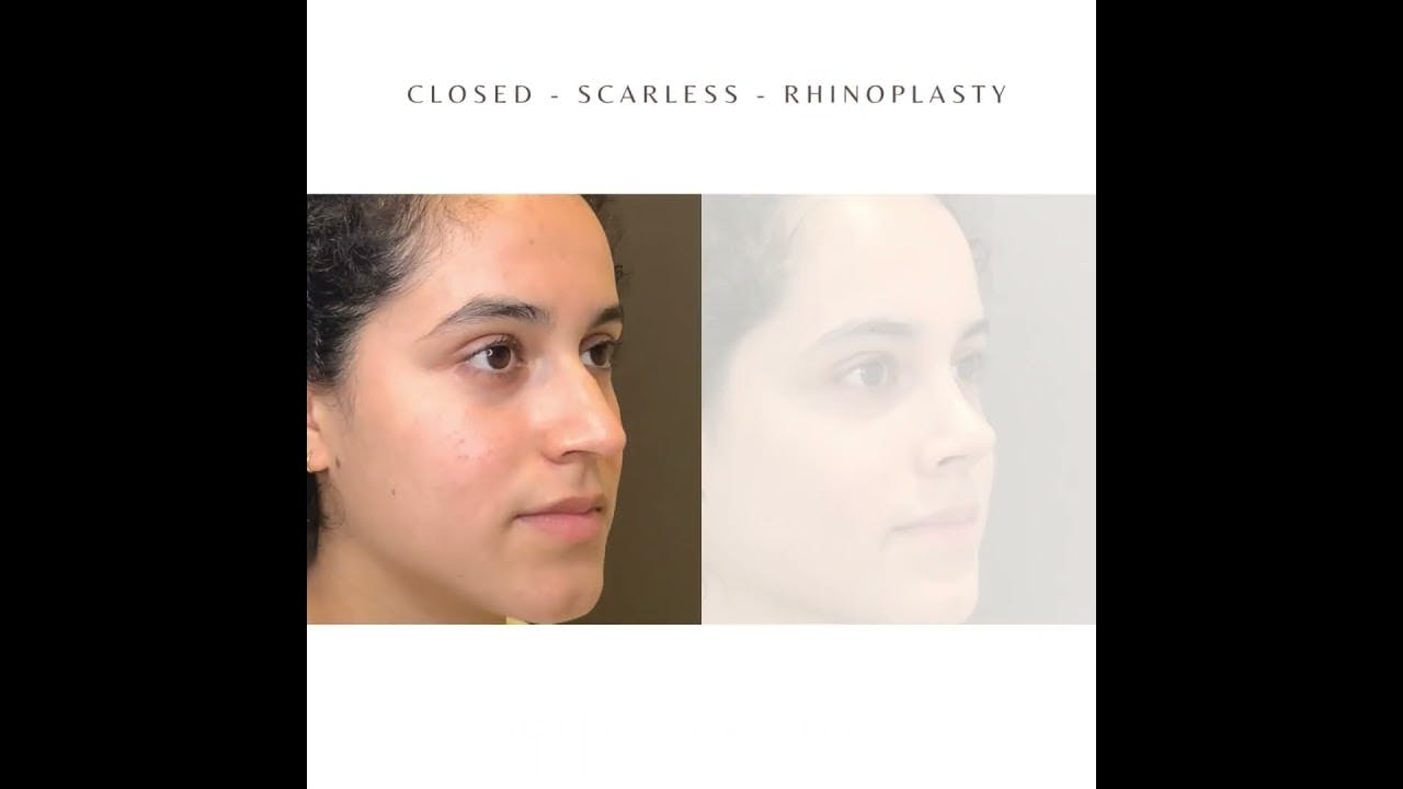 Closed Scarless Rhinoplasty Thumbnail