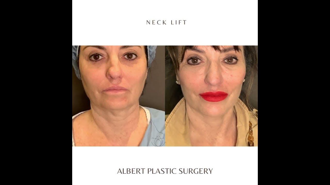 Post Neck Lift Surgery 18 Month Result