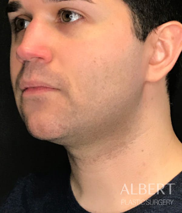Facial Implants Before & After Gallery - Patient 224298 - Image 1