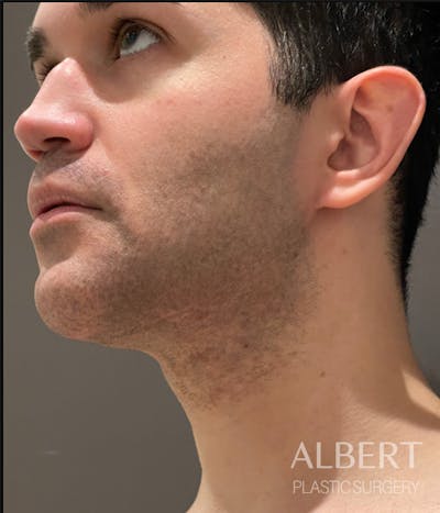 Facial Implants Before & After Gallery - Patient 224298 - Image 2