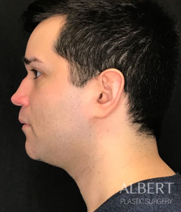 Facial Implants Before & After Gallery - Patient 224298 - Image 3