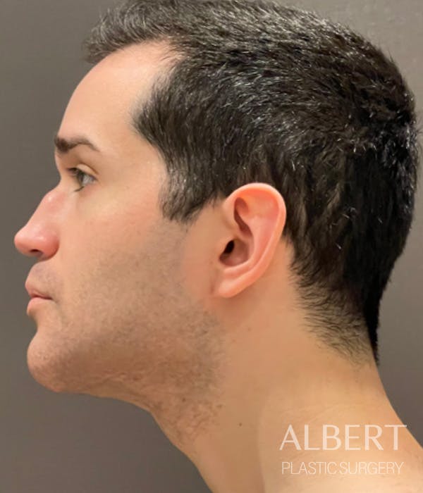 Facial Implants Before & After Gallery - Patient 224298 - Image 4