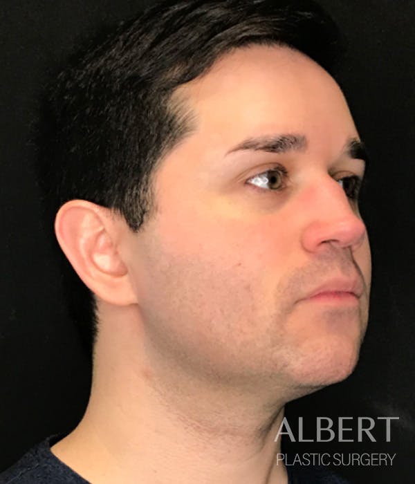 Facial Implants Before & After Gallery - Patient 224298 - Image 5