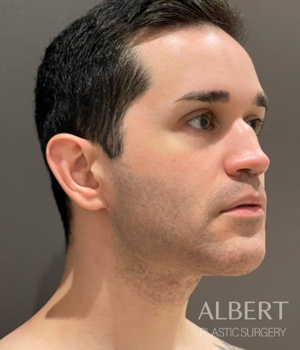 Facial Implants Before & After Gallery - Patient 224298 - Image 6