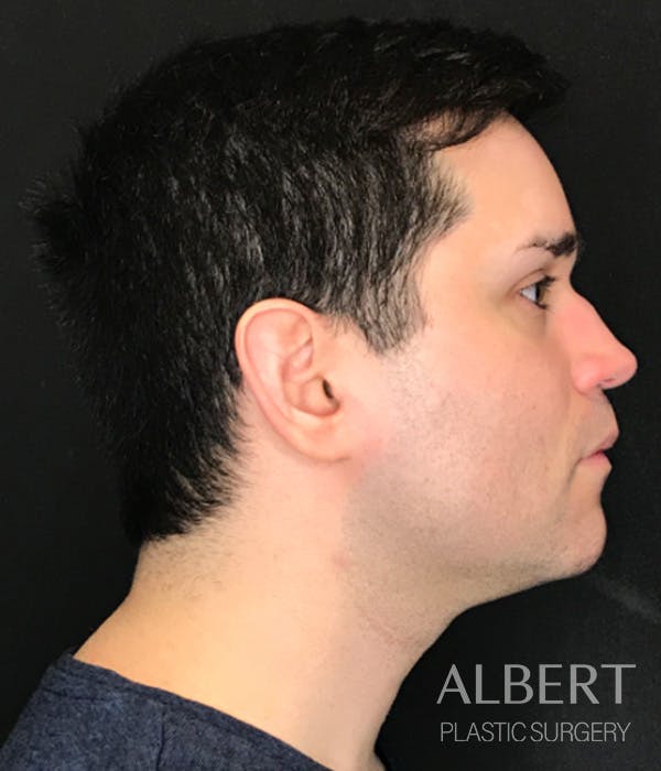 Facial Implants Before & After Gallery - Patient 224298 - Image 7