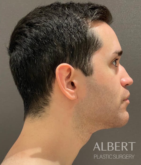 Facial Implants Before & After Gallery - Patient 224298 - Image 8