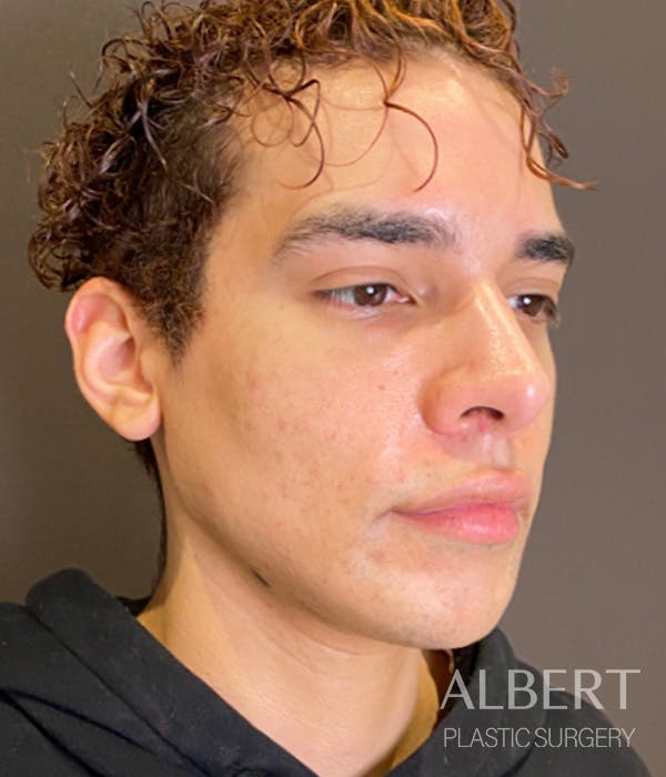 Facial Implants Before & After Gallery - Patient 131659 - Image 6