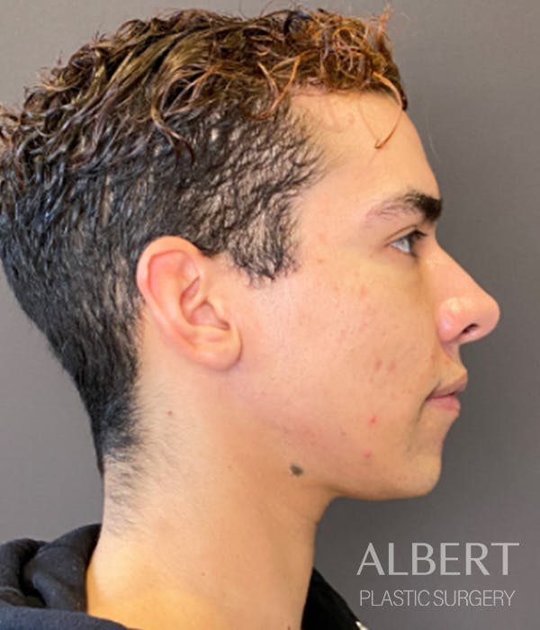Facial Implants Before & After Gallery - Patient 131659 - Image 5