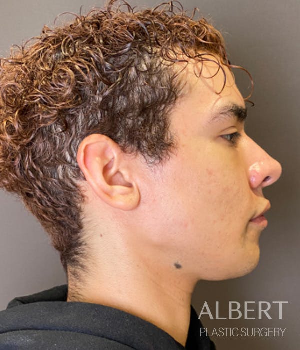 Facial Implants Before & After Gallery - Patient 131659 - Image 8