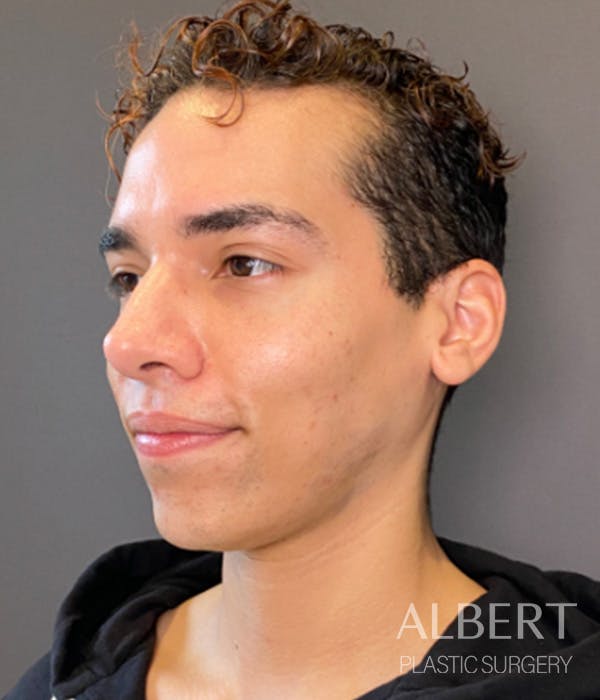 Facial Implants Before & After Gallery - Patient 131659 - Image 7