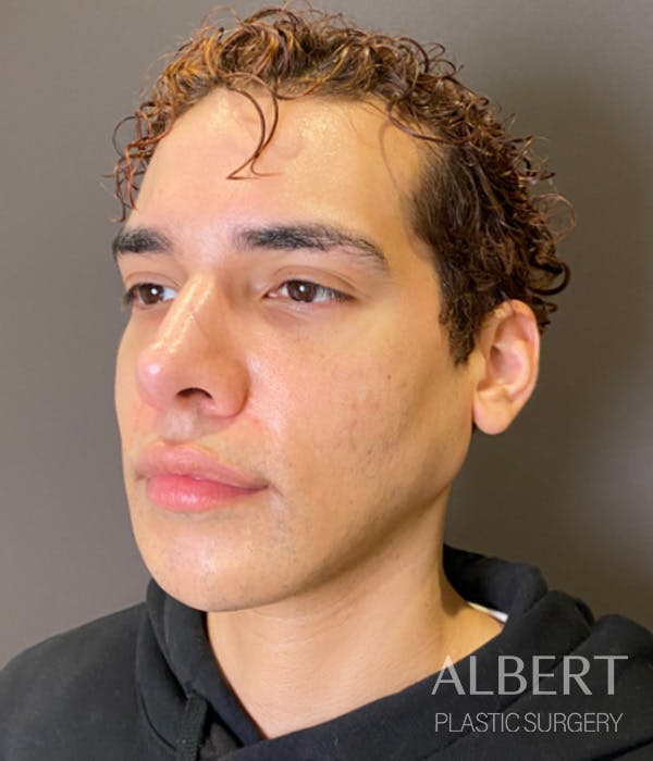Facial Implants Before & After Gallery - Patient 131659 - Image 8