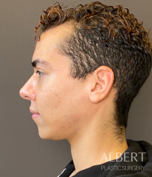 Facial Implants Before & After Gallery - Patient 131659 - Image 9