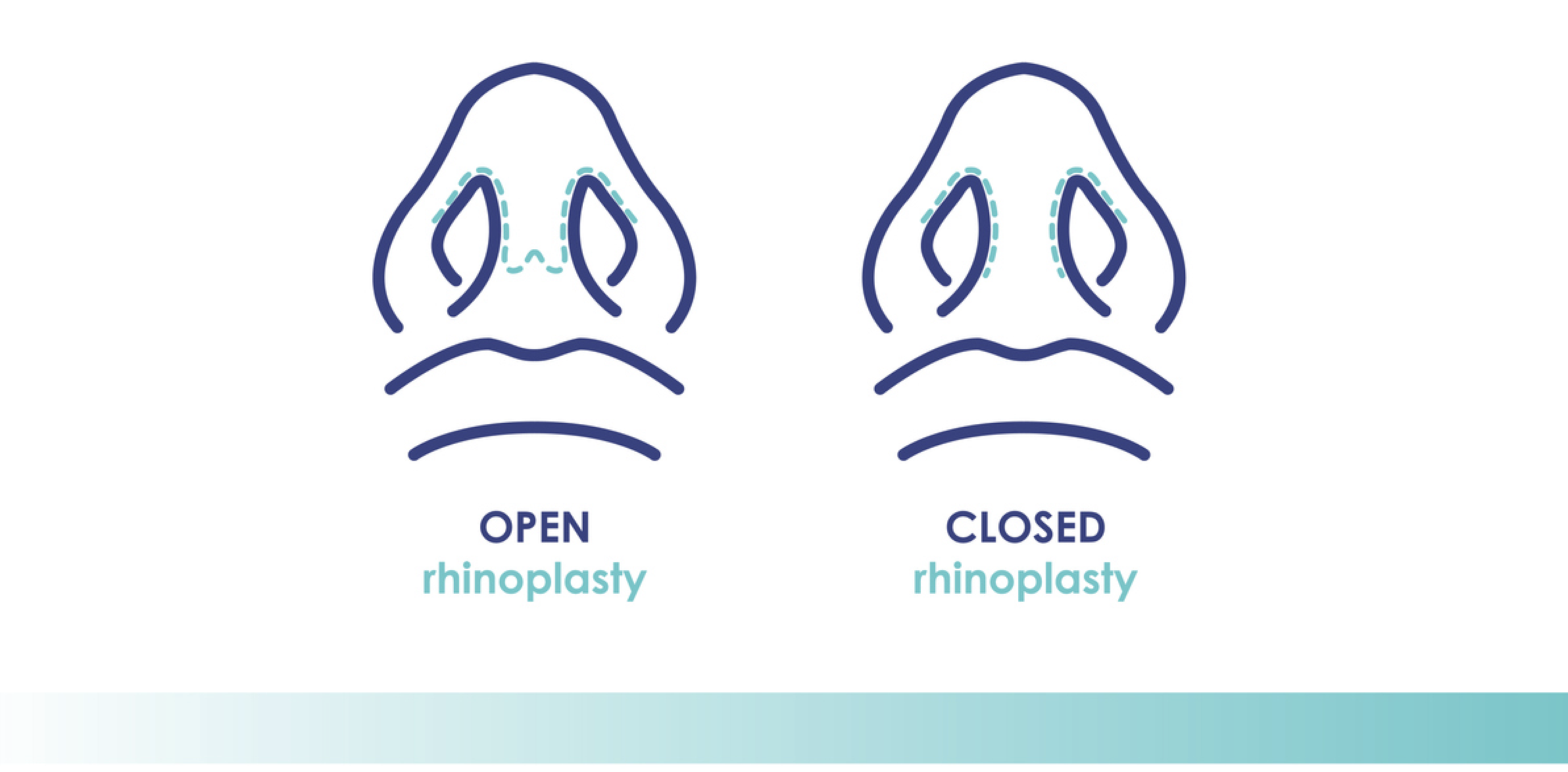closed vs open Rhinoplasty diagram