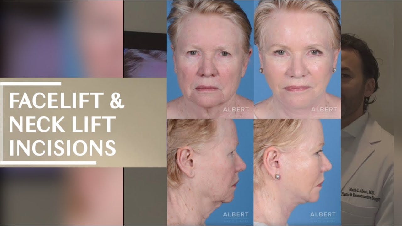 Facelift & Necklift Incisions vid thumbnail