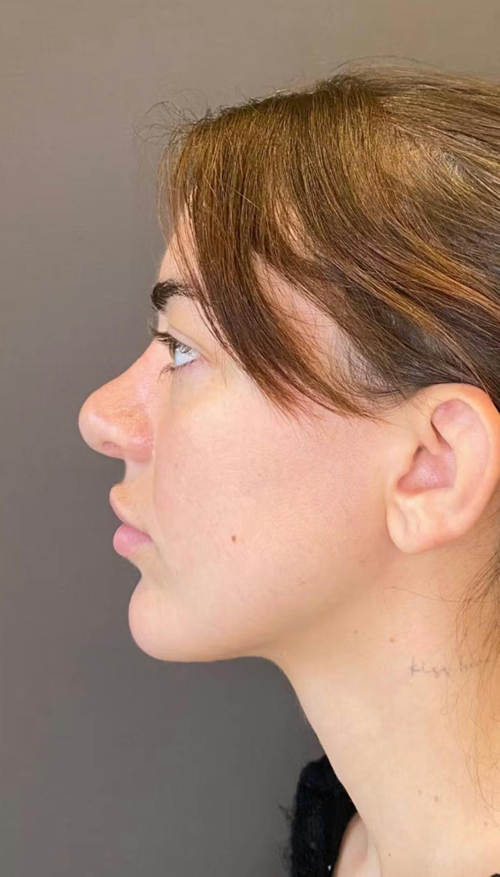 Revision Rhinoplasty Before & After Gallery - Patient 317183 - Image 1
