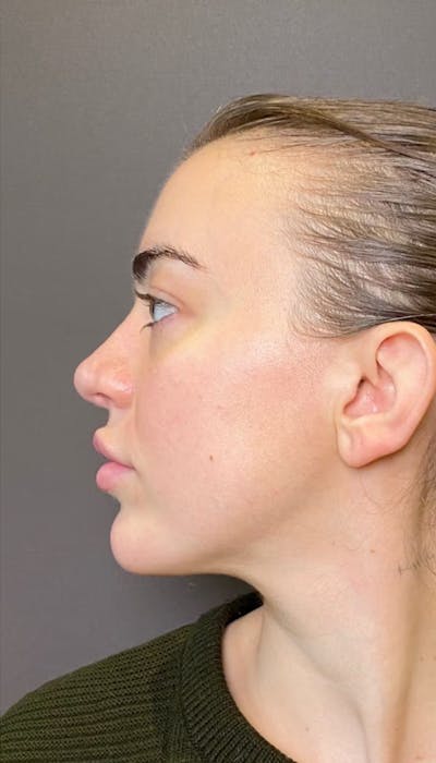 Revision Rhinoplasty Before & After Gallery - Patient 317183 - Image 2