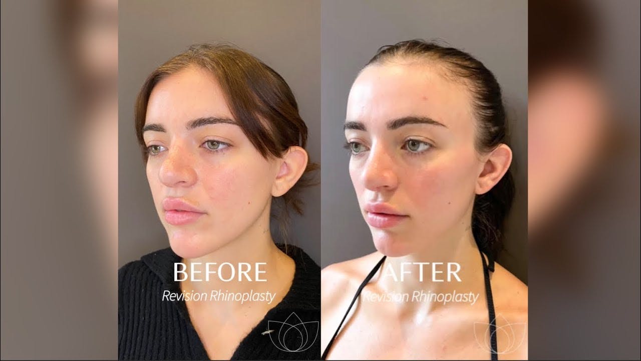 Revision Rhinoplasty Results Video Thumbnail