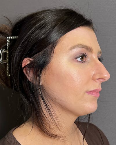 Chin Augmentation Before & After Gallery - Patient 899214 - Image 1