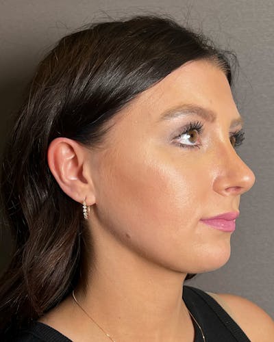 Rhinoplasty Before & After Gallery - Patient 191294715 - Image 2