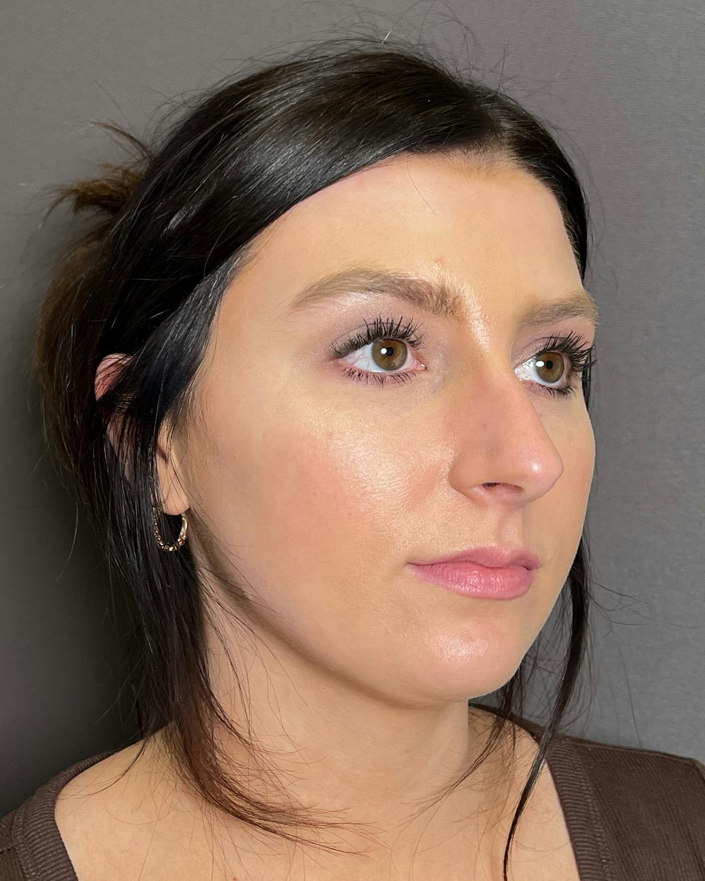 Rhinoplasty Before & After Gallery - Patient 191294715 - Image 3