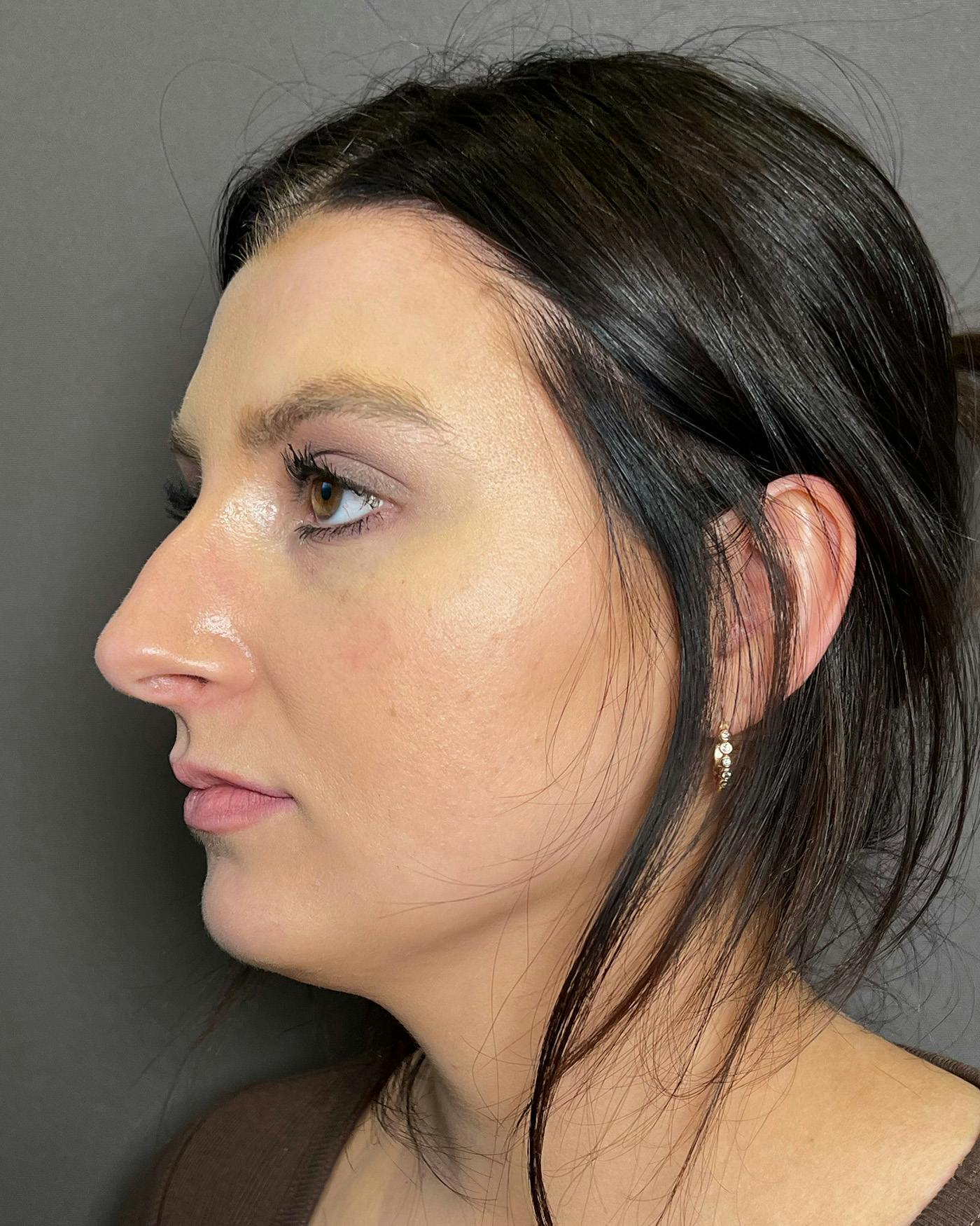 Chin Augmentation Before & After Gallery - Patient 899214 - Image 5
