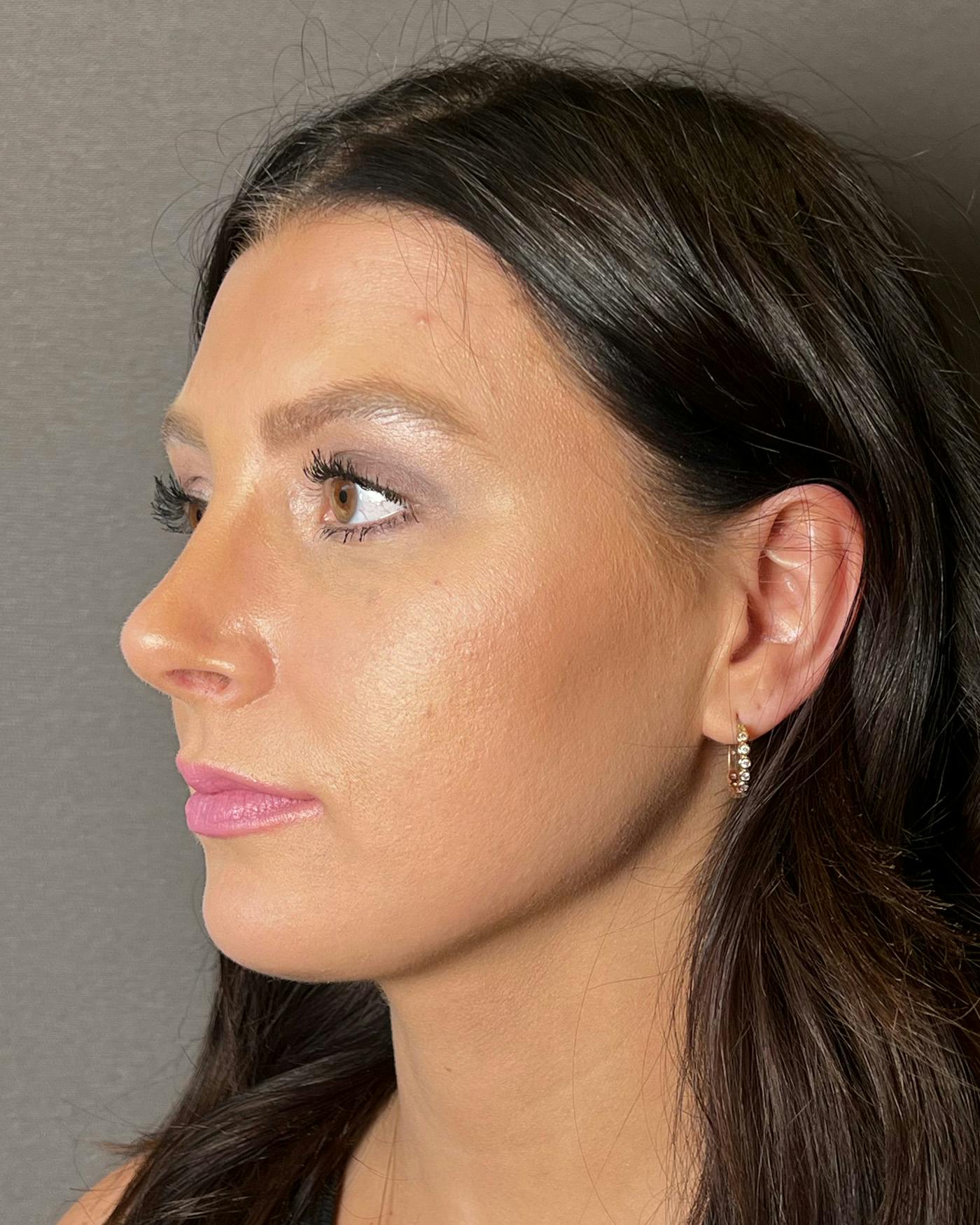 Rhinoplasty Before & After Gallery - Patient 191294715 - Image 6