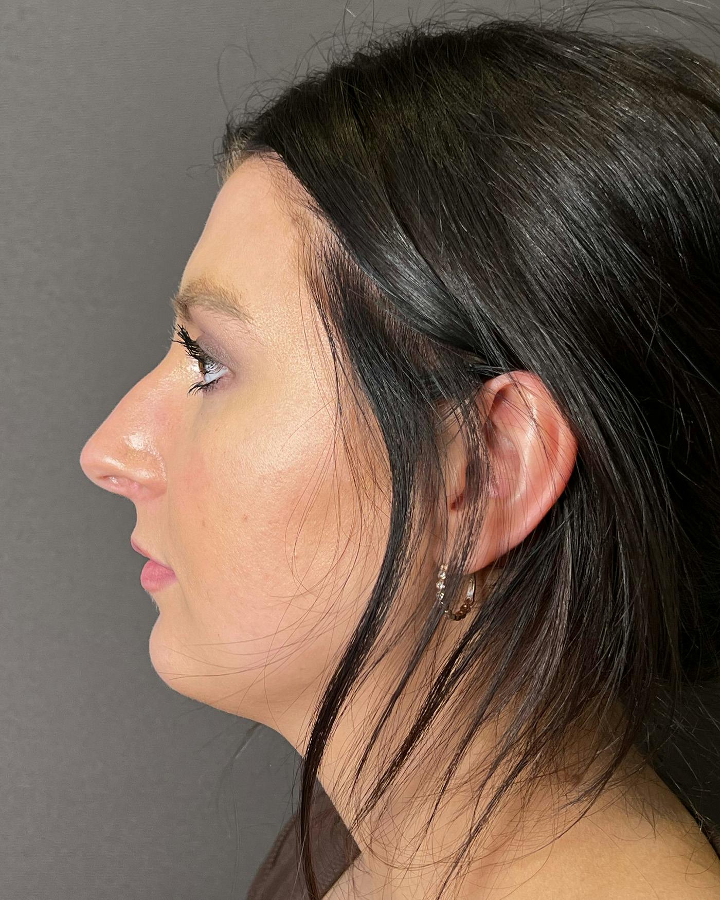 Chin Augmentation Before & After Gallery - Patient 899214 - Image 7