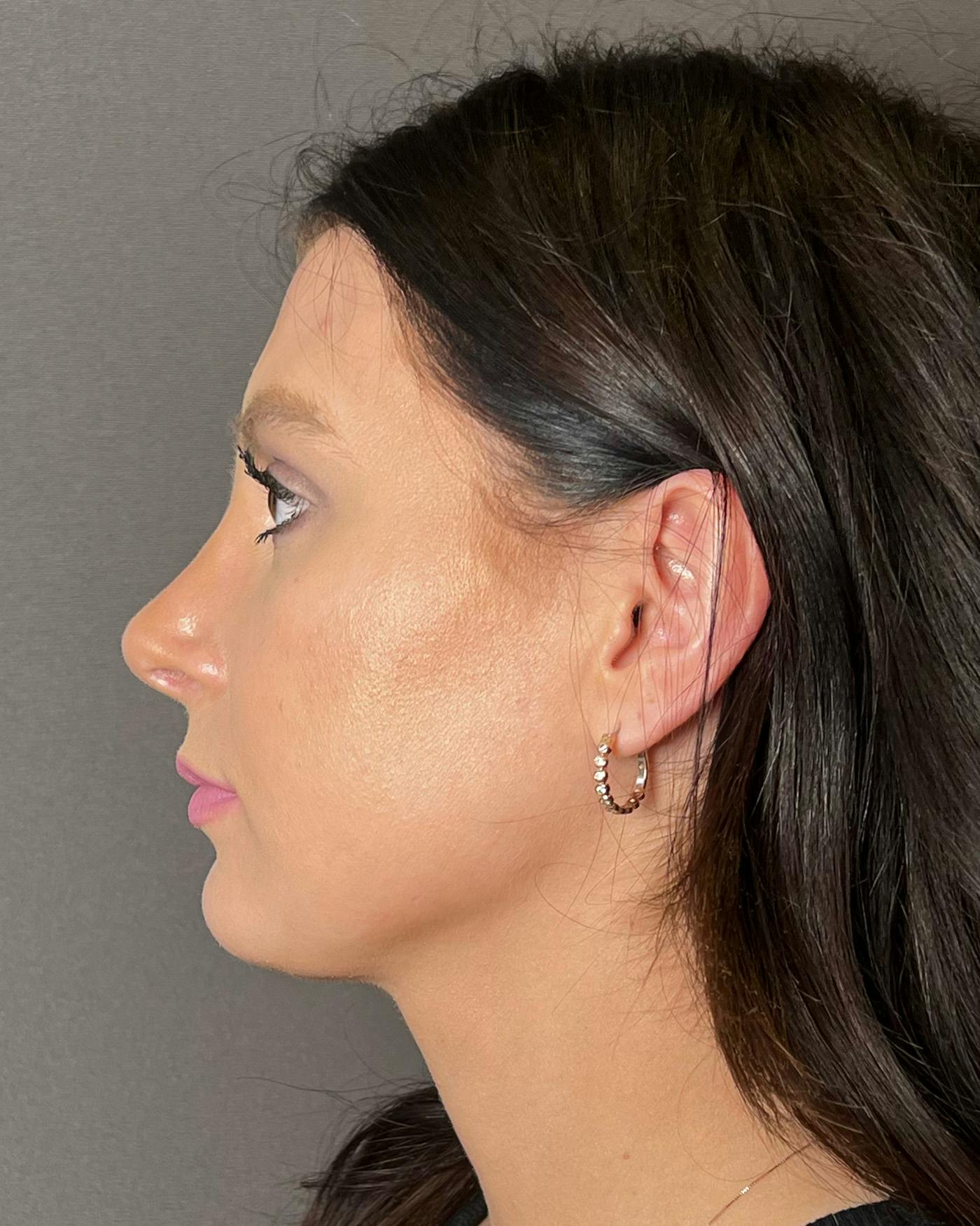 Chin Augmentation Before & After Gallery - Patient 899214 - Image 8