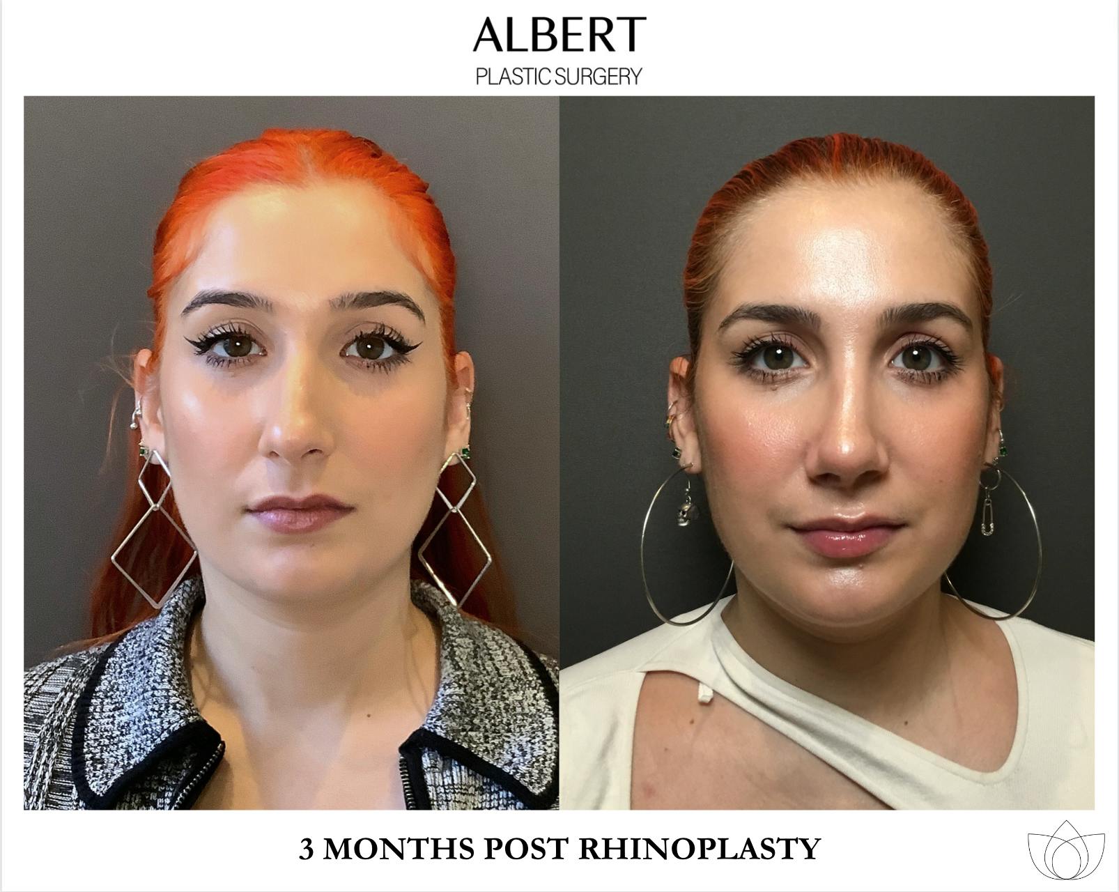 Rhinoplasty Before & After Gallery - Patient 143120 - Image 3