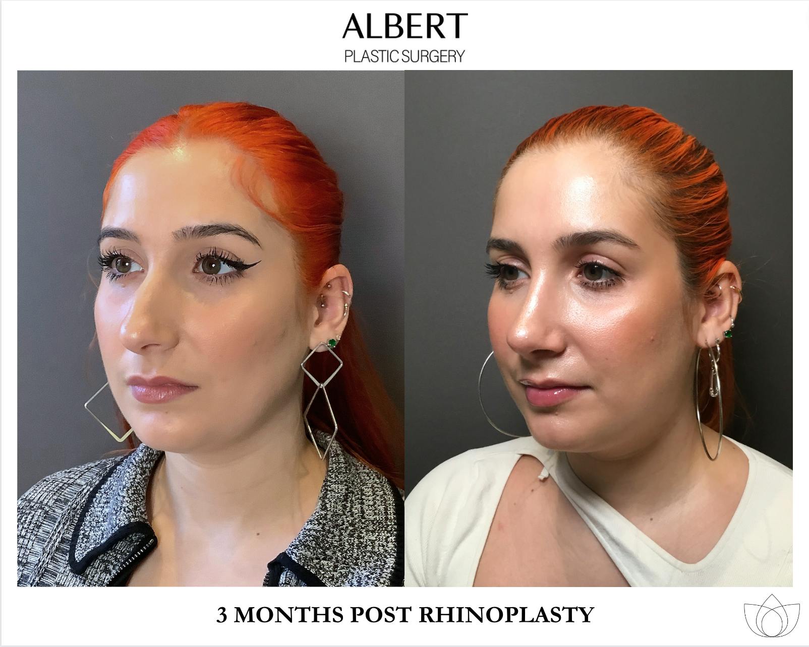 Rhinoplasty Before & After Gallery - Patient 143120 - Image 4