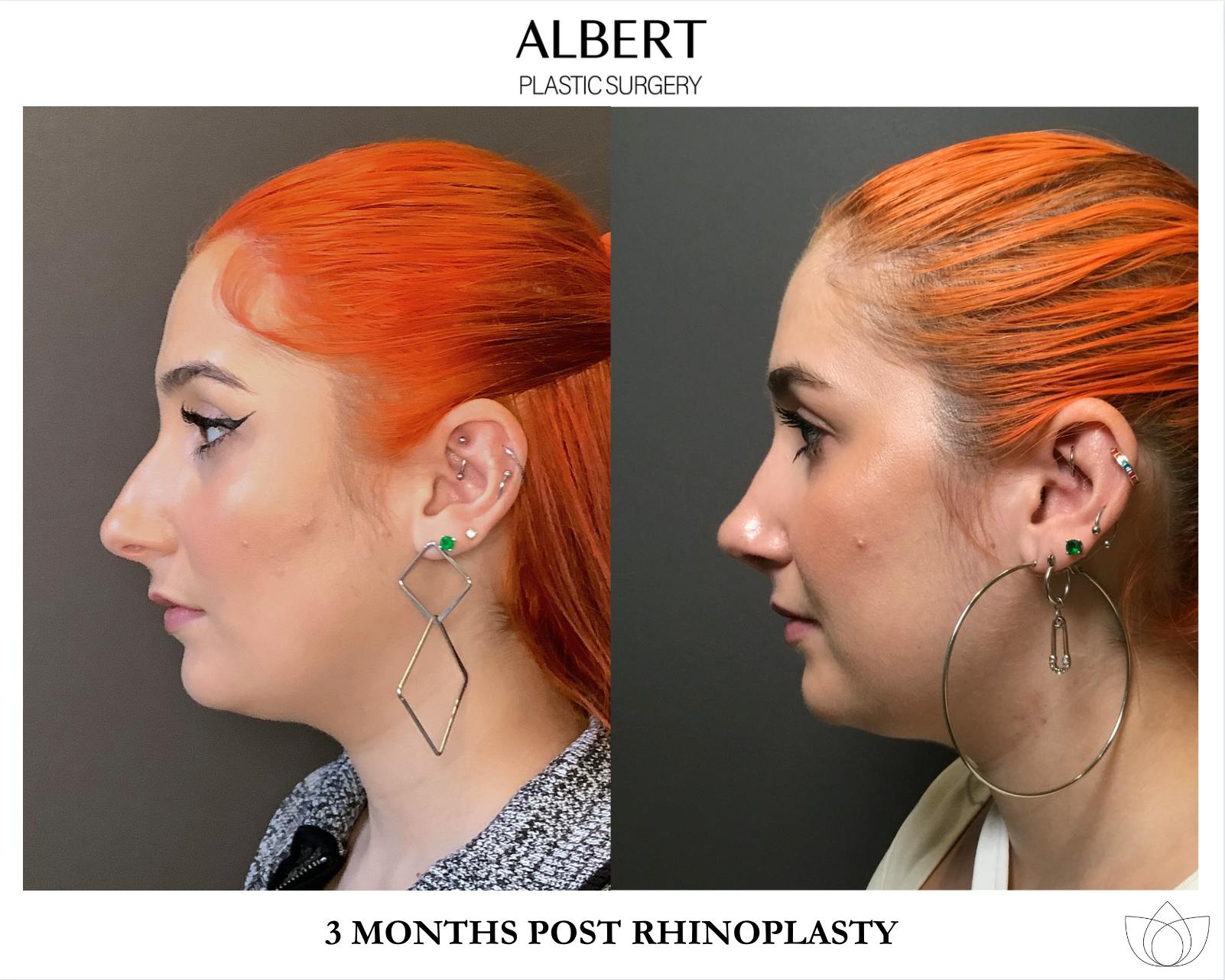Rhinoplasty Before & After Gallery - Patient 143120 - Image 5