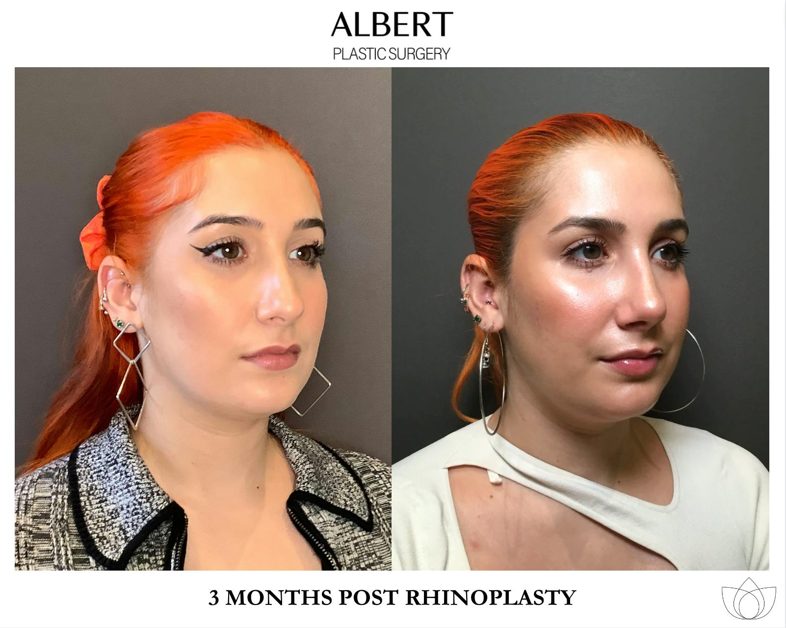 Rhinoplasty Before & After Gallery - Patient 143120 - Image 2